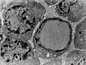 M, | intranuclear inclusion - plasmocyte, tonsilla palatina